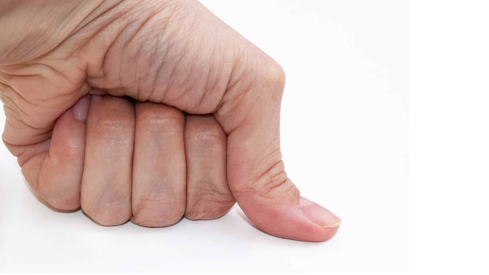 Té ngã chống tay xuống đất có thể gây trật khớp ngón tay cái