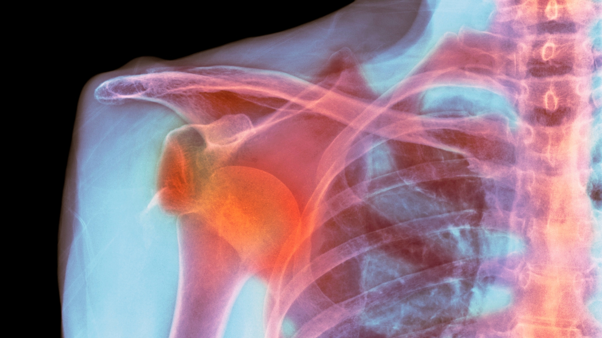 Trật khớp vai tái hồi là tình trạng đầu xương cánh tay liên tục trượt ra khỏi ổ chảo của xương vai do cấu trúc giữ khớp bị tổn thương sau lần trật khớp ban đầu