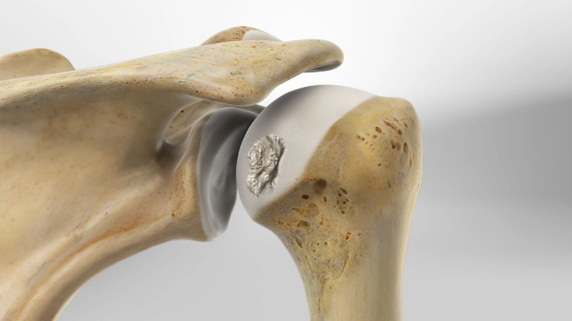 Khi chỏm xương cánh tay va đập mạnh vào bờ ổ chảo trong lúc trật khớp, có thể gây lõm xương (Hill-Sachs)