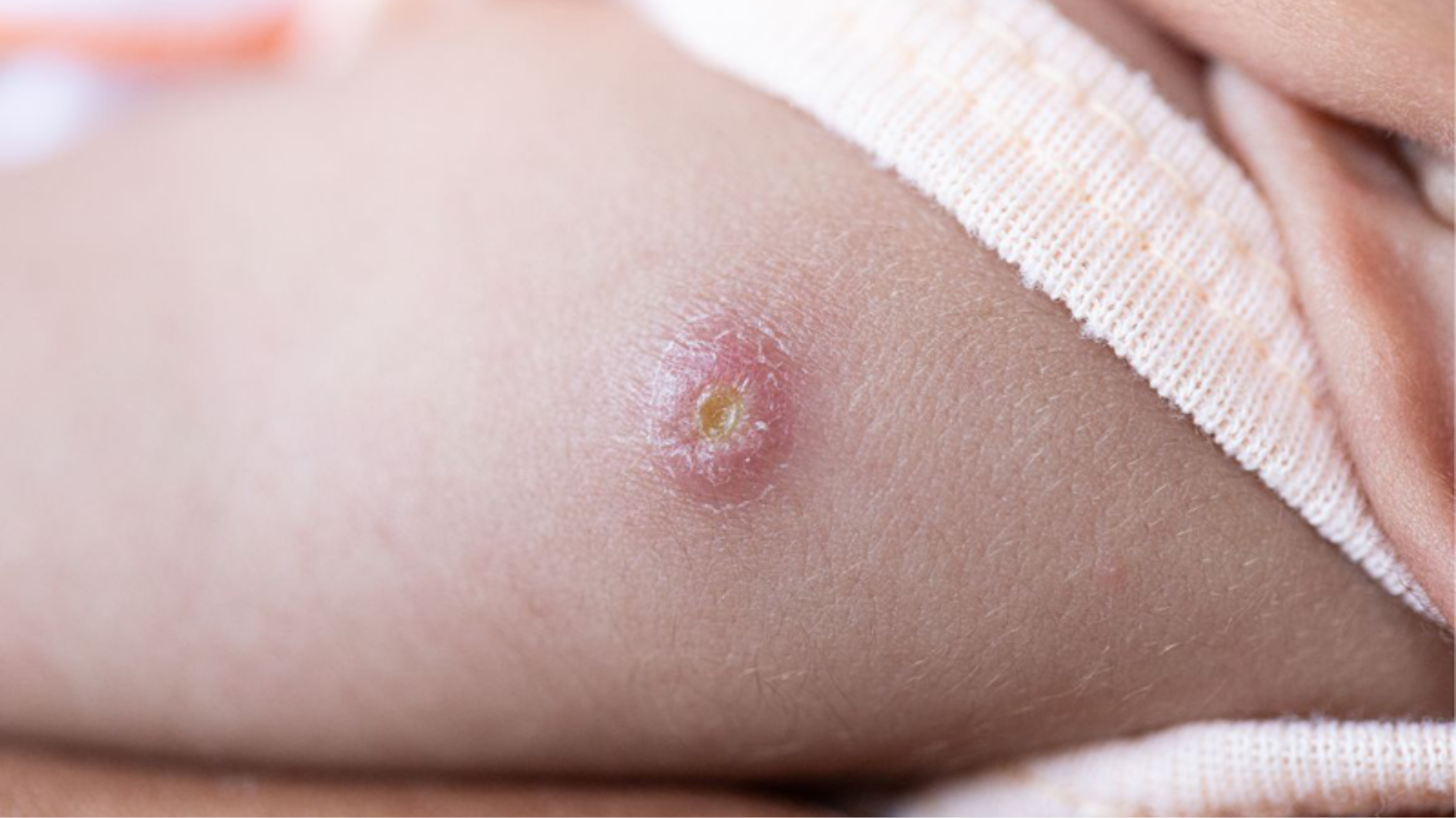 tre-bi-ap-xe-sau-khi-tiem-phong-co-sao-khong-cha-me-can-lam-gi (2).png