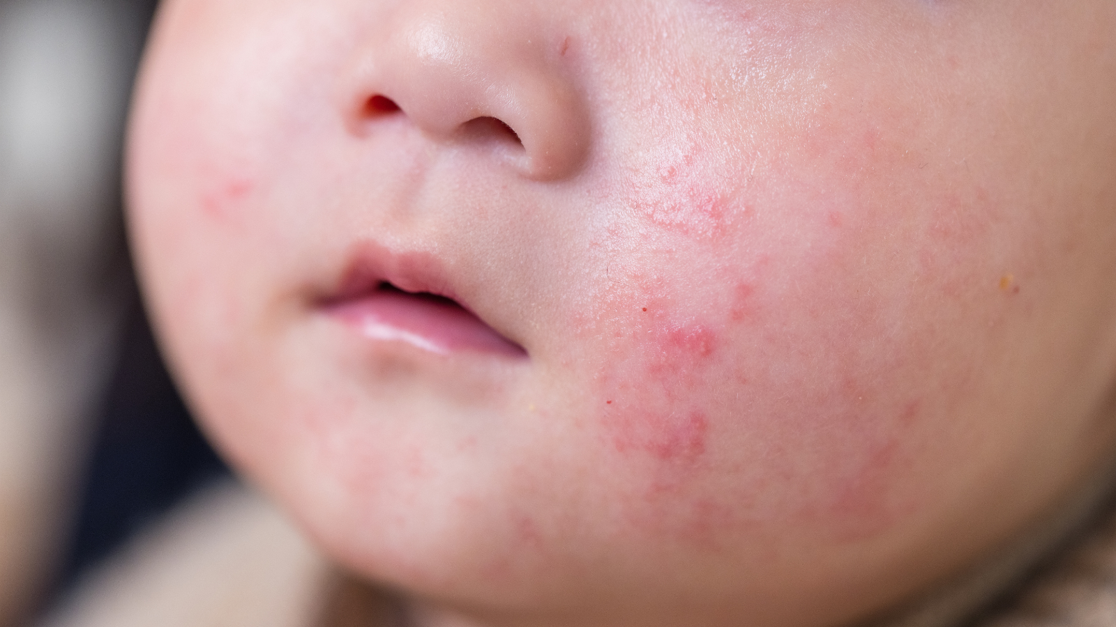 Trẻ bị chàm khô: Da mỏng và nhạy cảm dễ tổn thương