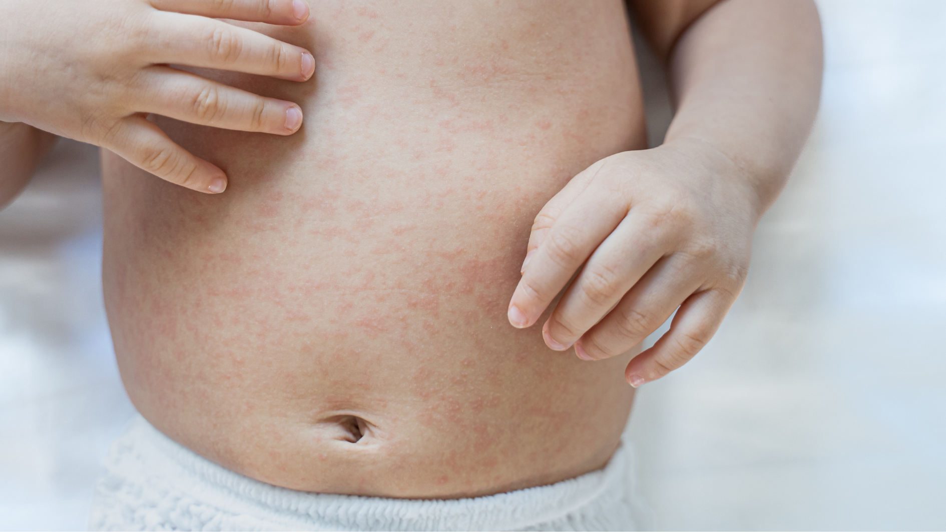 tre-bi-phat-ban-sau-sot-can-kieng-gi (1).png