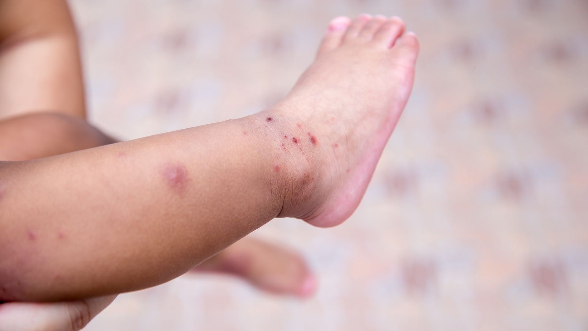 Trẻ bị tay chân miệng tắm lá gì? Những lưu ý cha mẹ cần biết 3