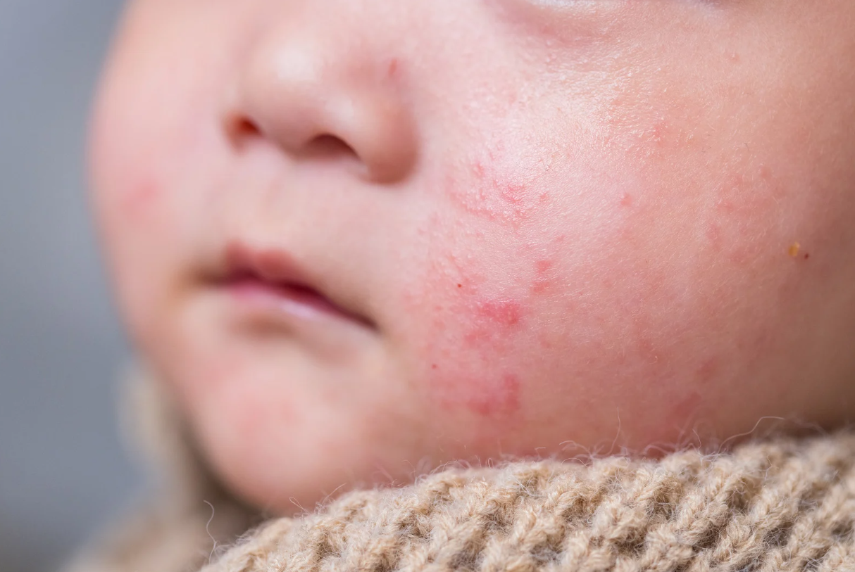 tre-noi-man-do-sau-khi-tiem-phong-co-nguy-hiem-khong 1.png