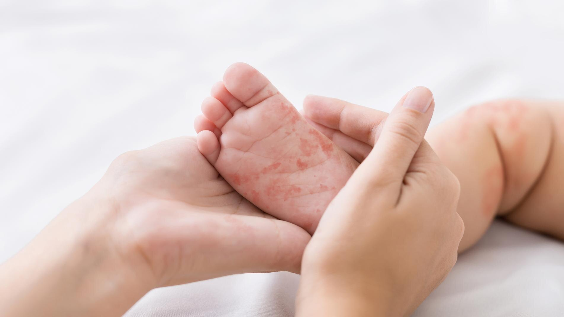 tre-sau-sot-bi-noi-man-do-co-sao-khong-nguyen-nhan-va-cach-dieu-tri 3.jpeg