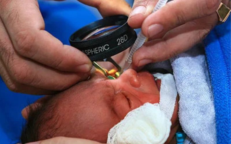 Quá trình khám mắt cho trẻ sinh non cần được thực hiện bởi bác sĩ chuyên ngành