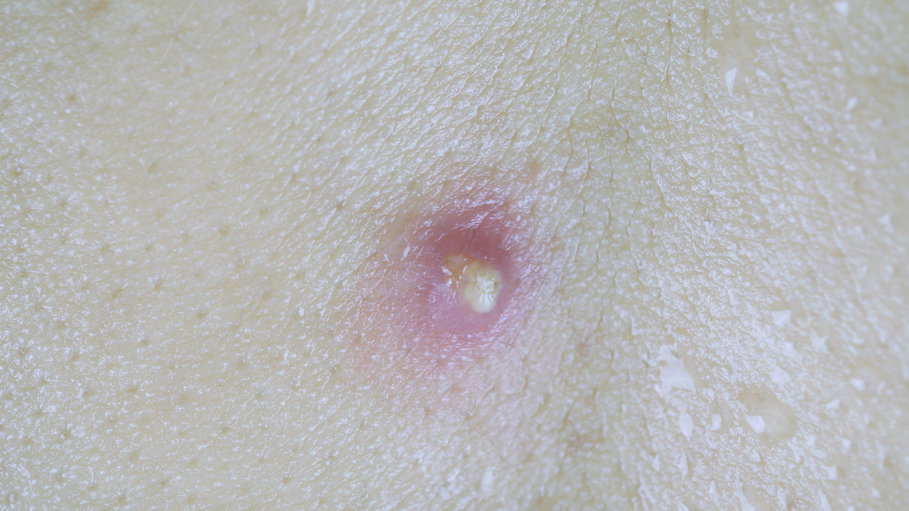 Trẻ sơ sinh bị áp xe có các dấu hiệu như vùng da sưng đỏ ngày càng to, nóng, đau, có mủ