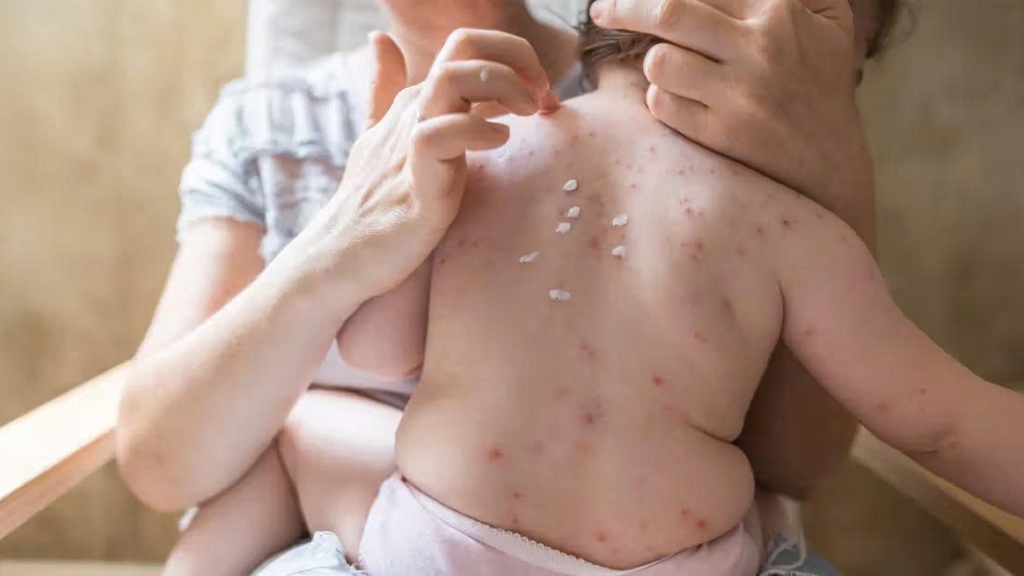 Trẻ sơ sinh bị giời leo có sao không? Dấu hiệu nhận biết và cách xử lý 3
