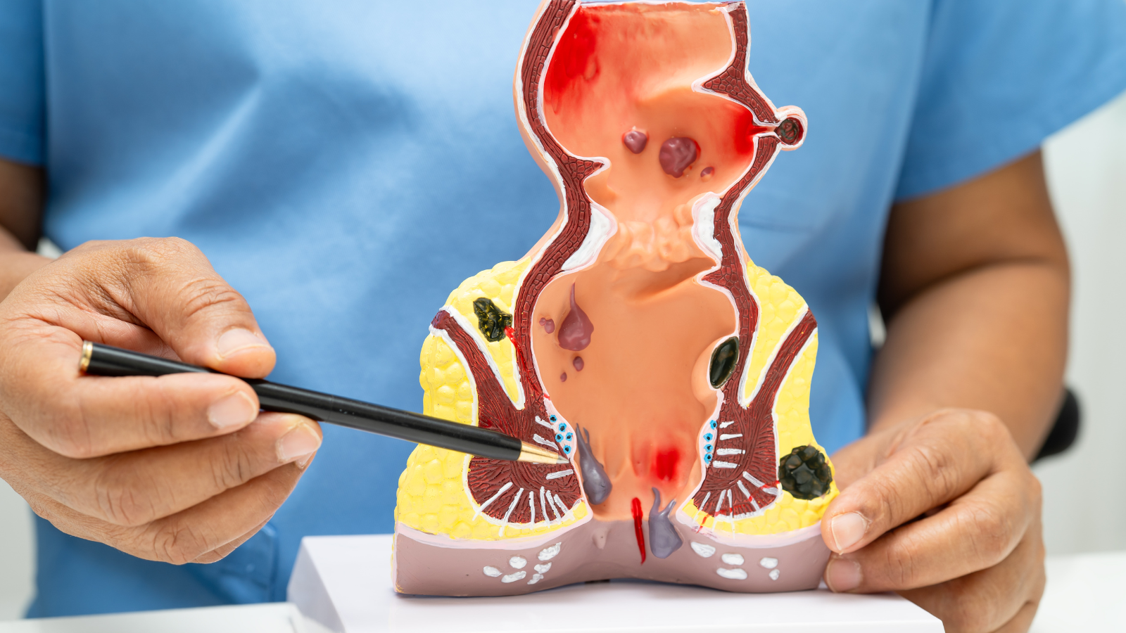 trĩ ngoại tắc mạch là một biến chứng cấp tính của trĩ ngoại