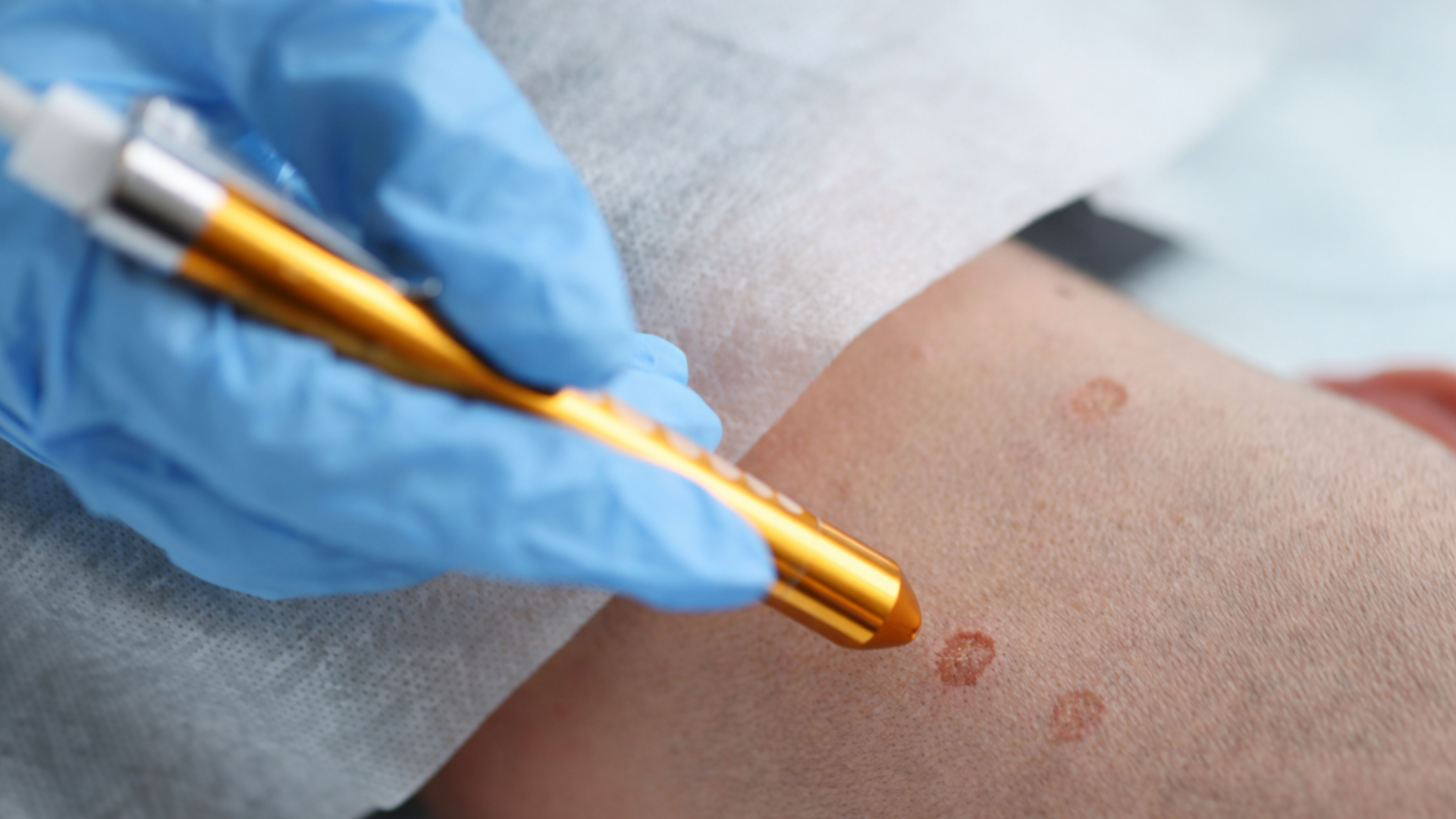 Trị sùi mào gà bằng phương pháp ALA PDT