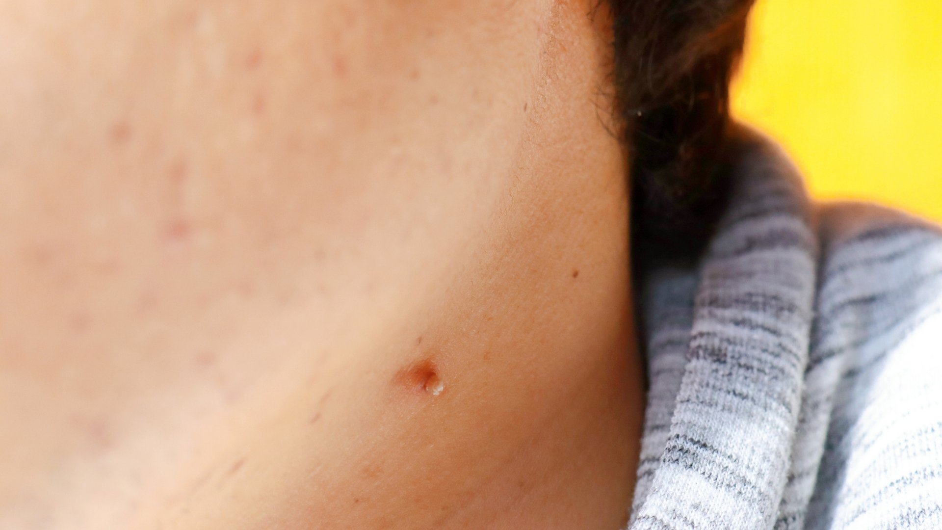 Quy trình trị sùi mào gà bằng phương pháp ALA PDT tại cơ sở y tế