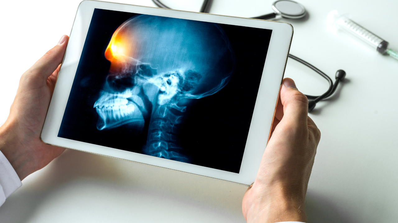 trieu-chung-benh-viem-mang-nao-mu-o-nguoi-lon (4).png