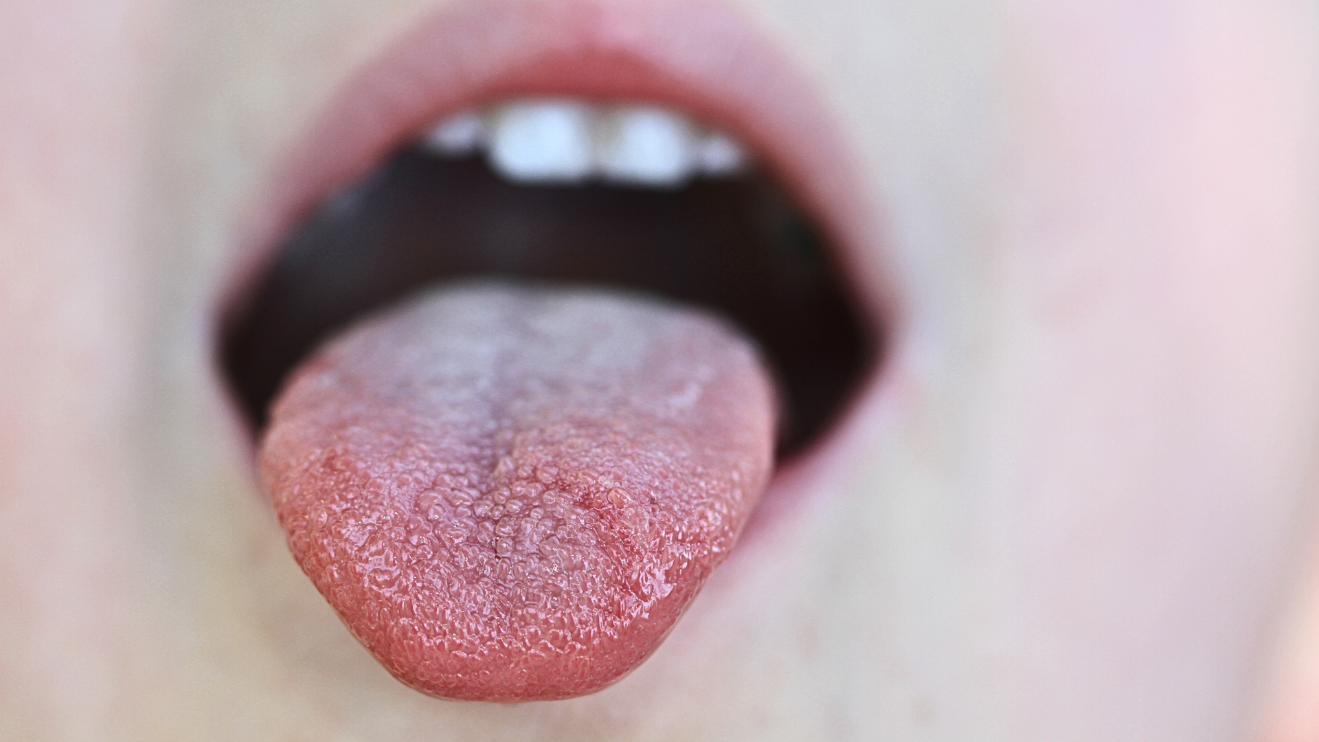 Triệu chứng của u nhú tiền đình là gì? Làm sao để phòng tránh tình trạng này? 1