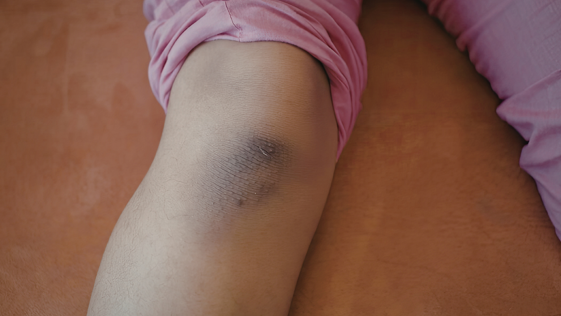 Vết bầm tím có thể xuất hiện sau vài ngày kể từ thời điểm chấn thương, do máu từ các mạch máu bị tổn thương thấm ra dưới da