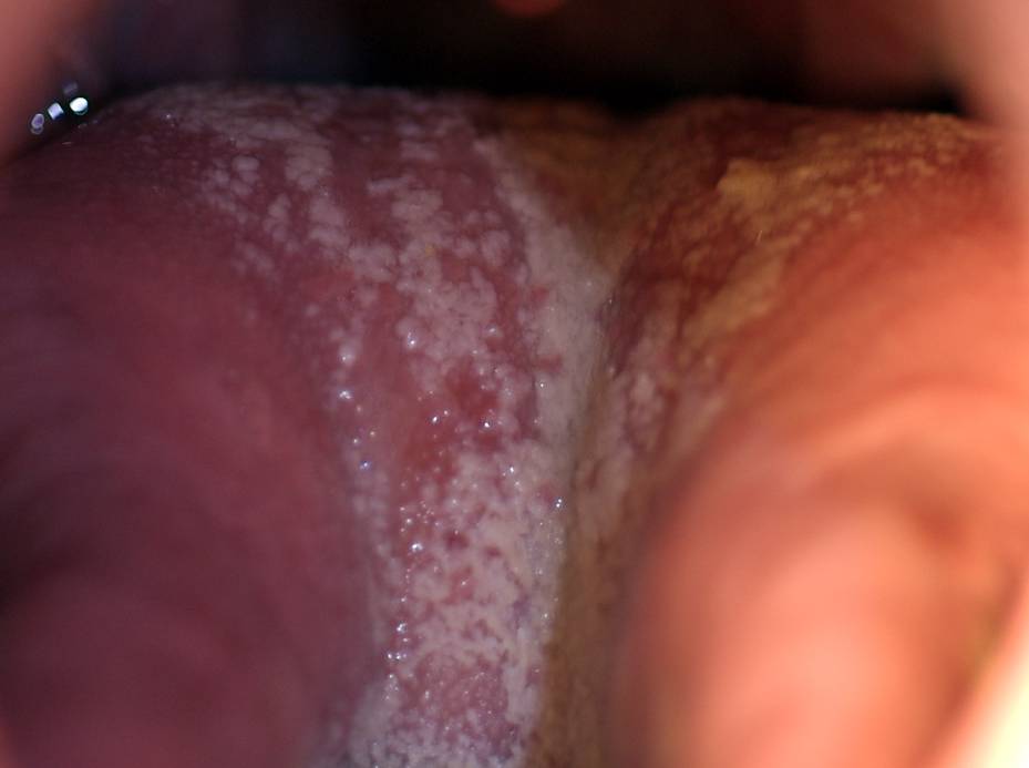 Triệu chứng HIV giai đoạn cuối là gì? Giải pháp làm chậm sự phát triển của HIV giai đoạn cuối 2
