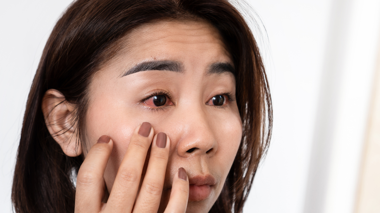 Triệu chứng mắt đỏ khi bị Covid-19 có nguy hiểm không? 2