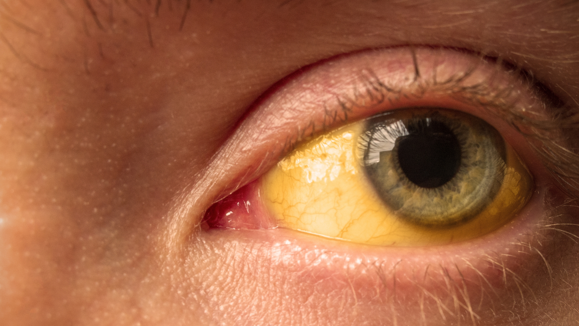 Vàng da và vàng mắt là triệu chứng đặc trưng khi nhiễm virus viêm gan A, thường xuất hiện rõ ở người lớn