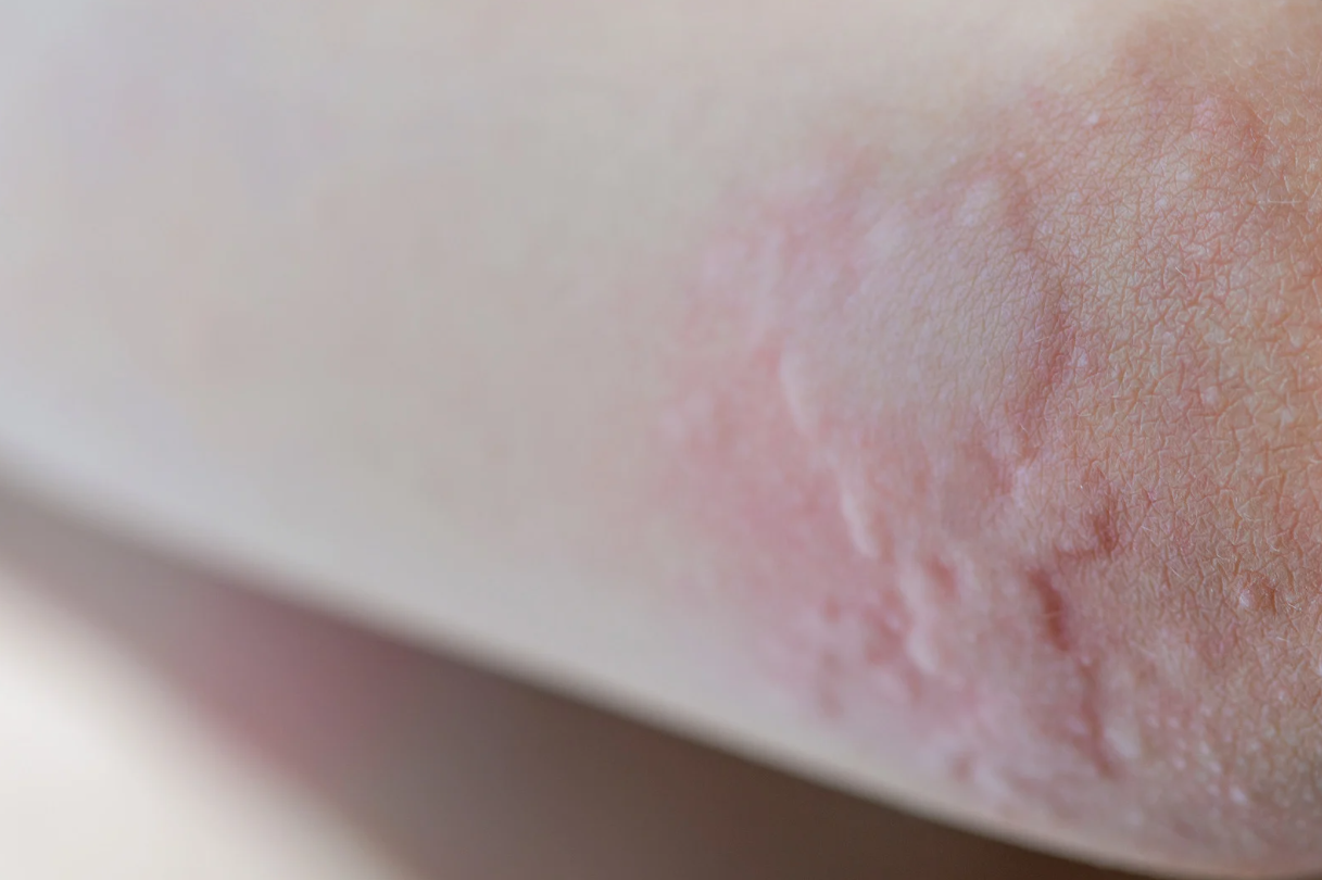 trieu-chung-sau-khi-tiem-vac-xin-nhung-dieu-can-biet 2.png