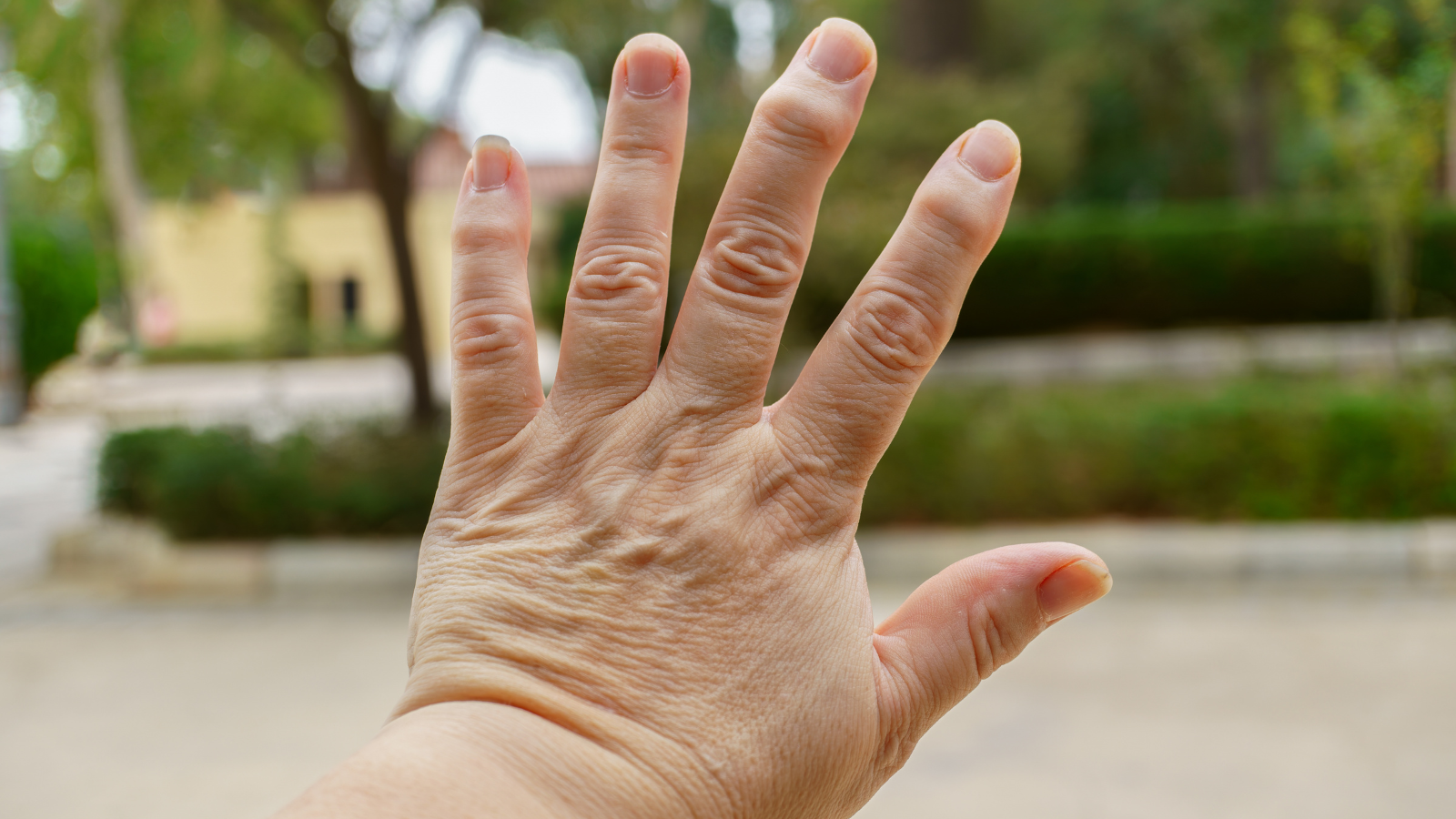 Khớp sưng và biến dạng là một trong các triệu chứng thoái hóa khớp