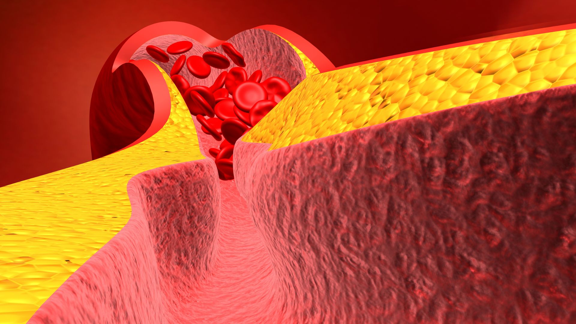 Mỡ máu cao có thể gây tắc nghẽn mạch, làm tăng nguy cơ đột quỵ và nhồi máu cơ tim