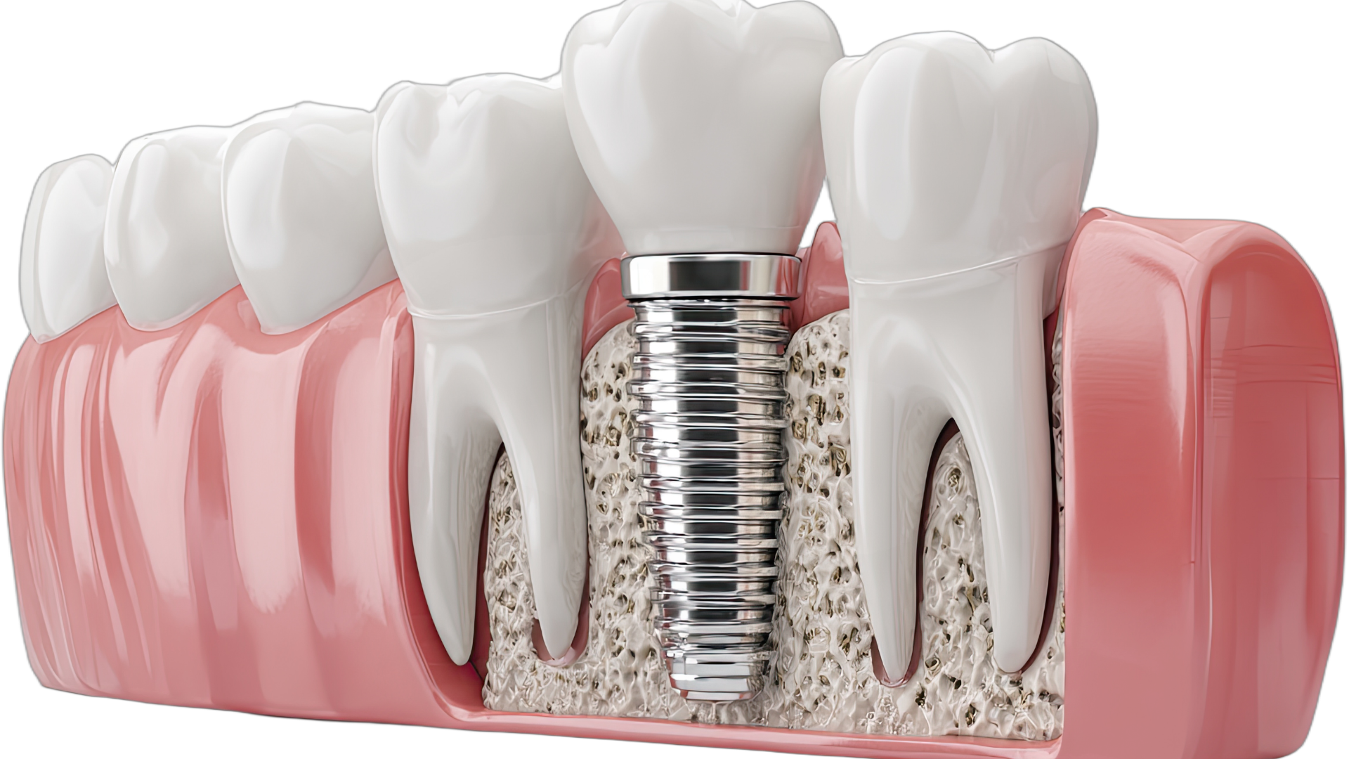 Trồng răng implant có đau không và cảm giác thực tế