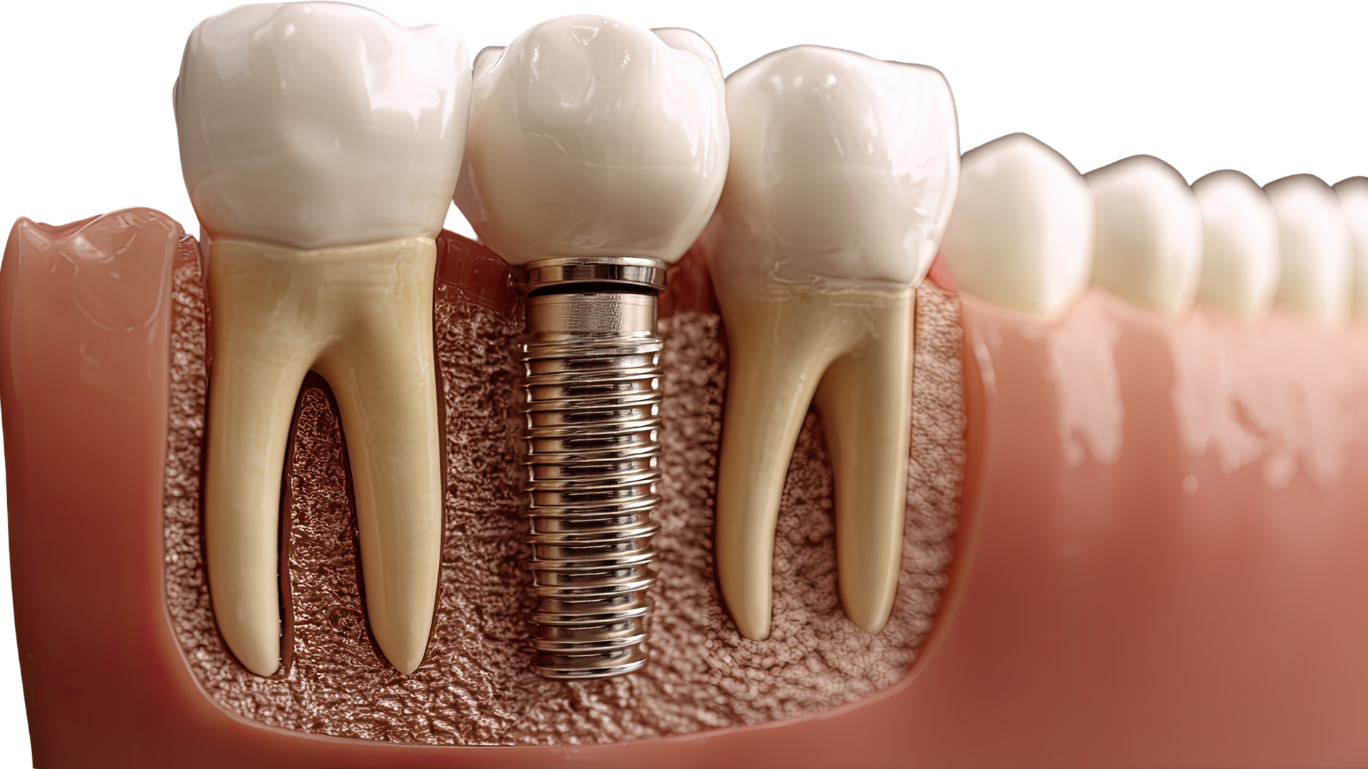 Những yếu tố ảnh hưởng đến mức độ đau khi trồng răng Implant