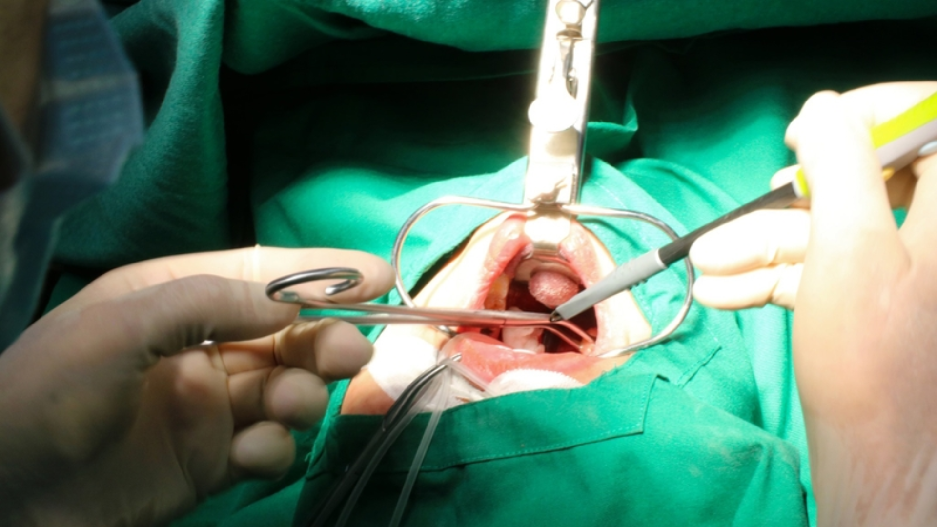 Phẫu thuật nhỏ, ít tiếp xúc máu như cắt amidan thường không cần xét nghiệm HIV trước