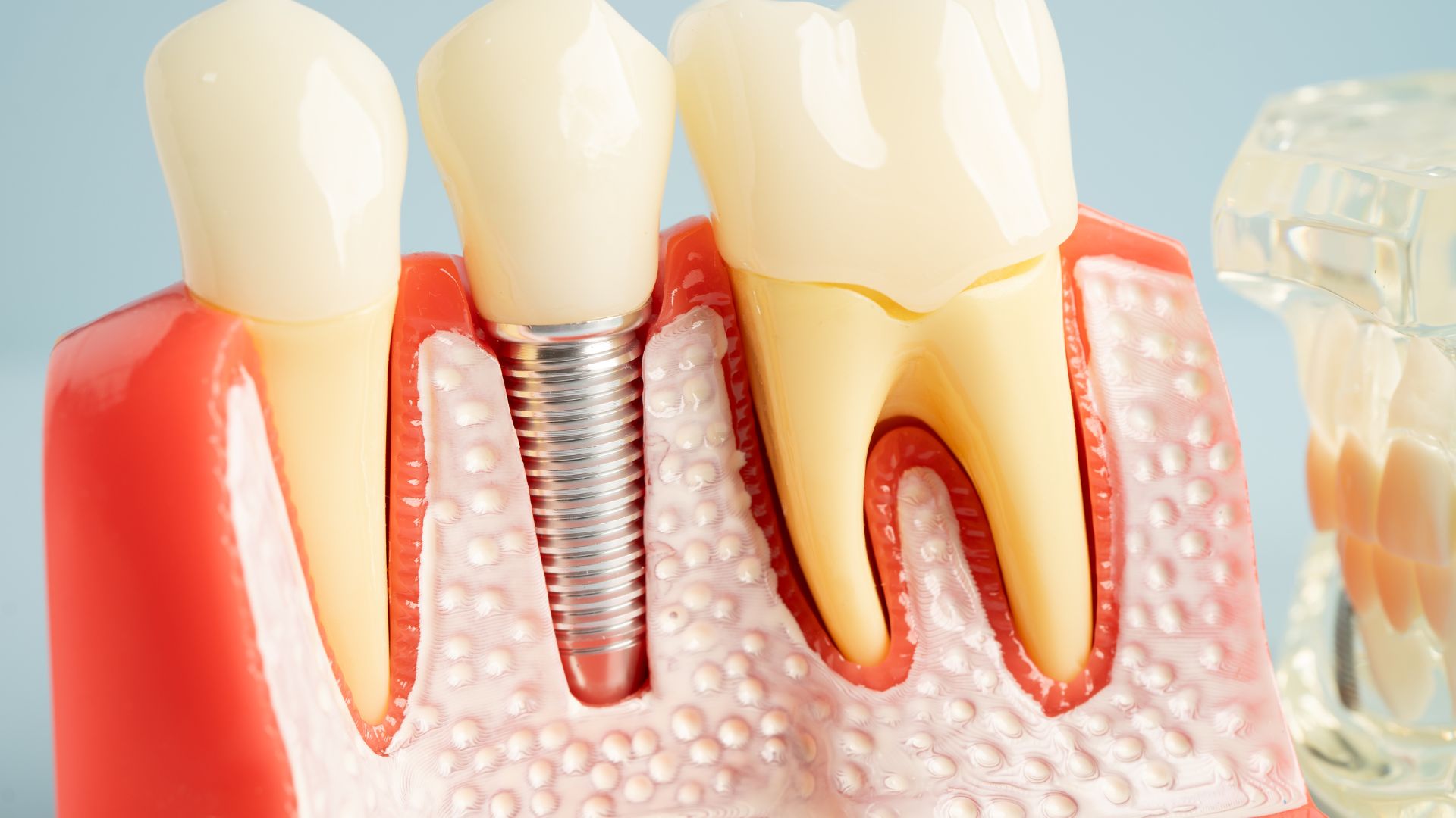 Tuổi thọ răng lấy tuỷ là bao lâu?