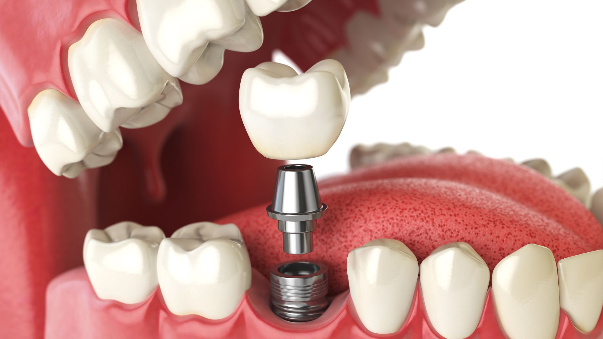 Cấy ghép Implant cũng là một biện pháp để duy trì sức khỏe răng