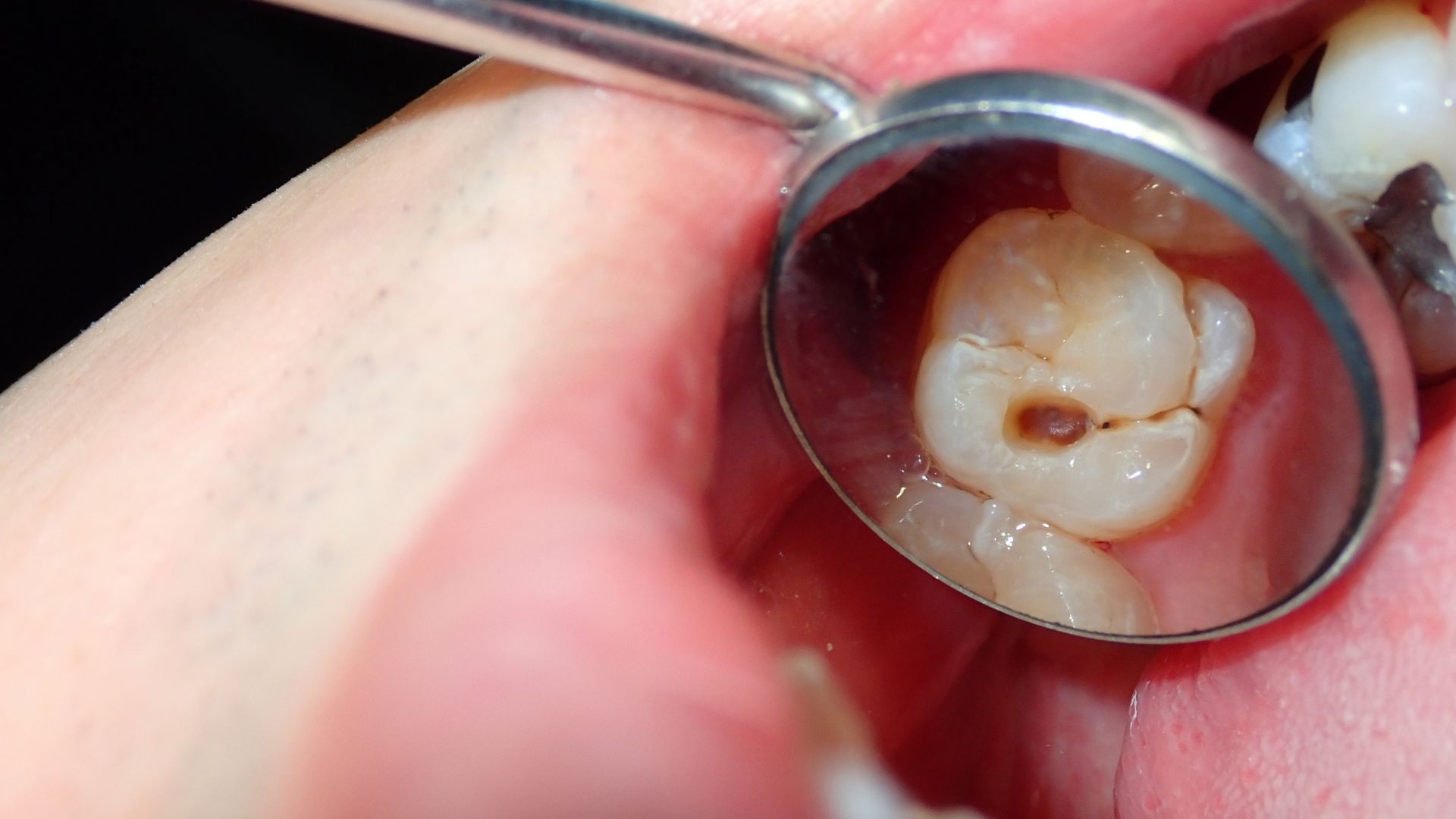Buồng tủy và ống tủy là 2 thành phần chính của tủy răng