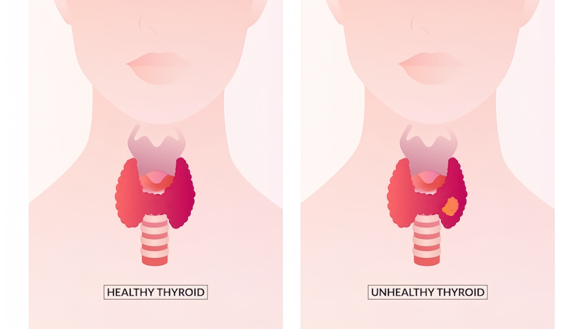 Tuyến giáp sưng to là tình trạng như thế nào?