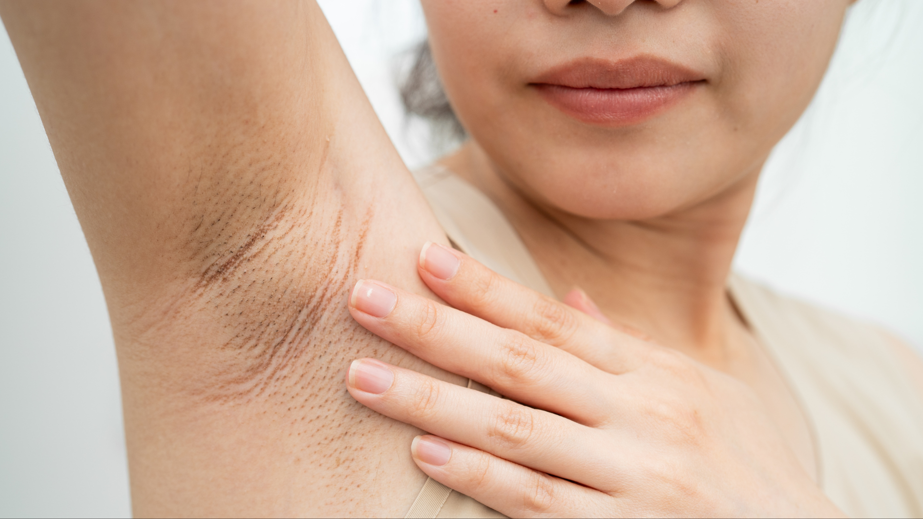 Tuyến vú phụ ở nách thường do bẩm sinh