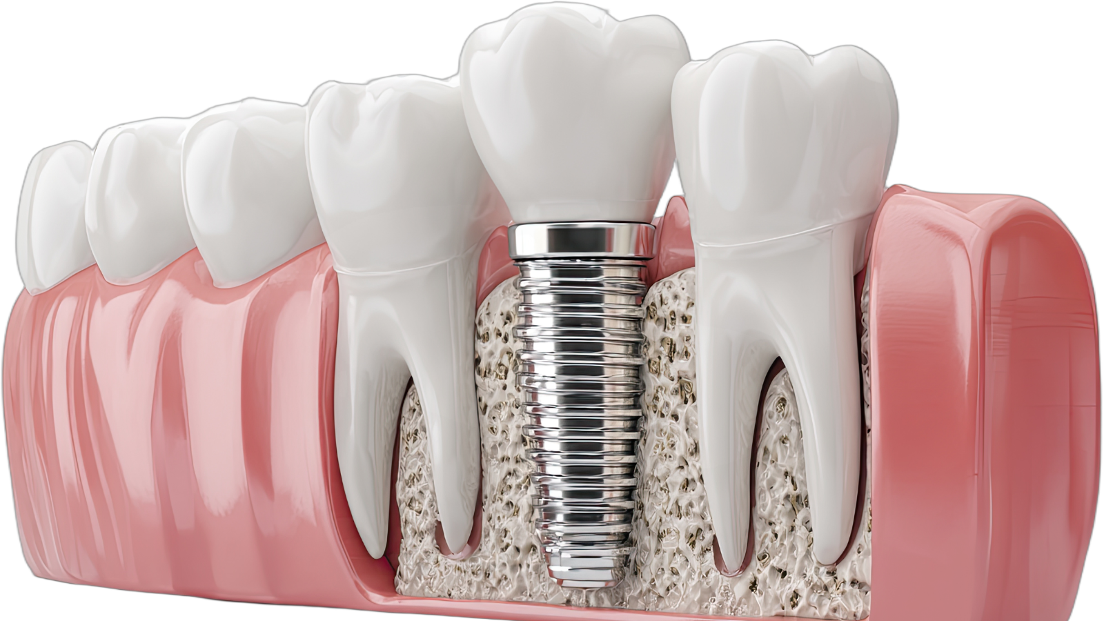 Cắm implant kiêng ăn gì: Chế độ dinh dưỡng giúp trụ tích hợp xương nhanh chóng 1