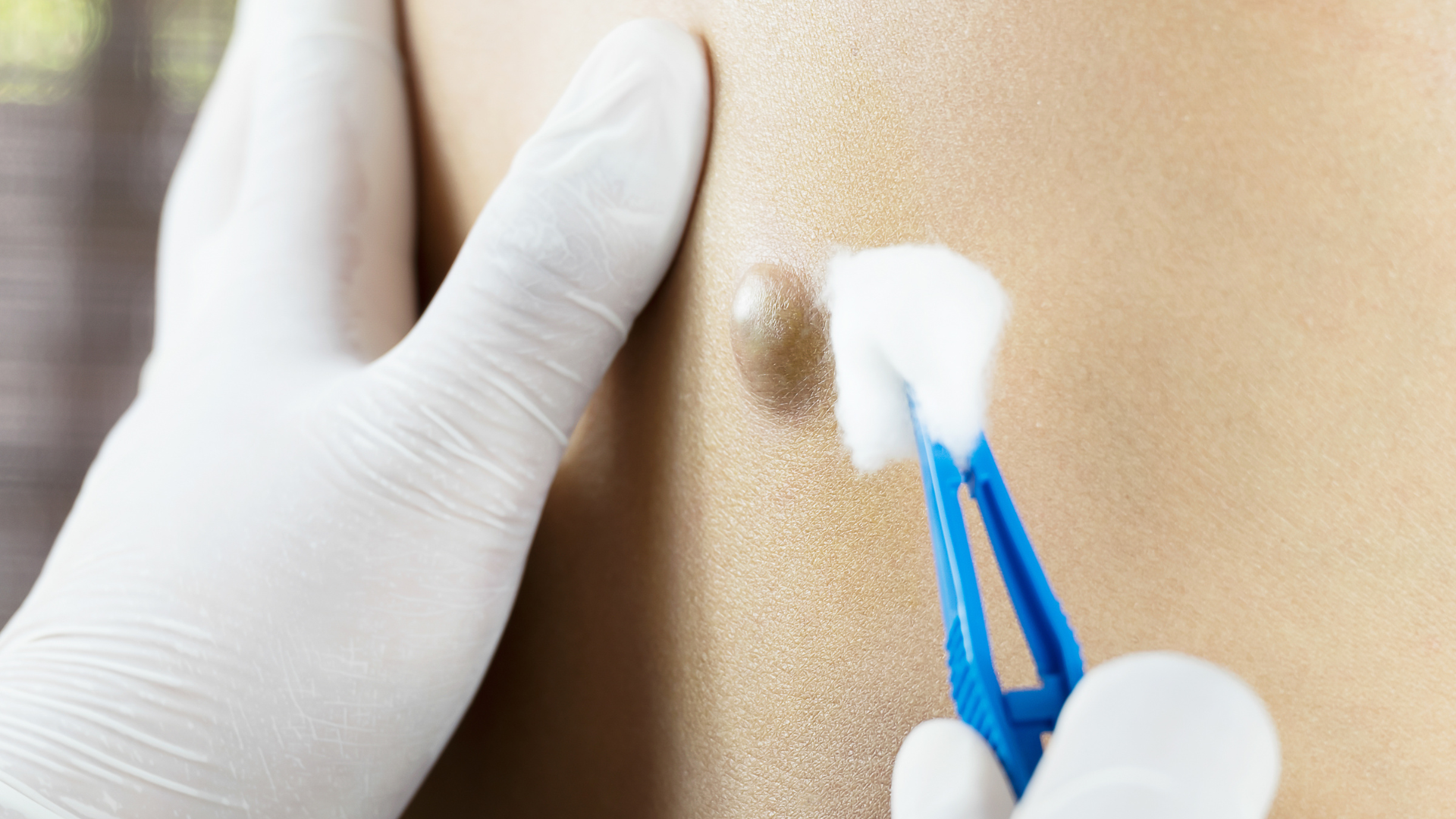 Khi nào u bã đậu cần được kiểm tra y tế?