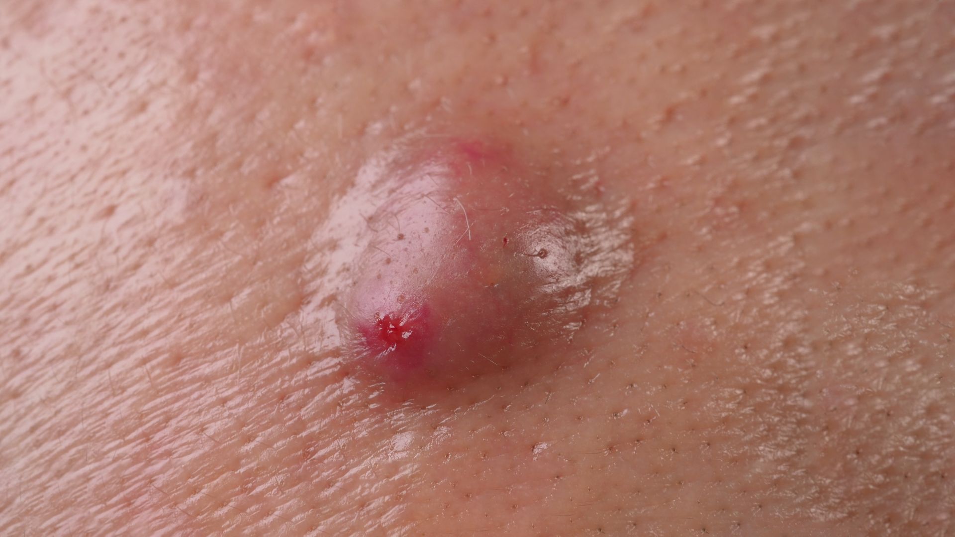 Người bệnh thường không cảm thấy khó chịu khi u bã đậu ở giai đoạn đầu