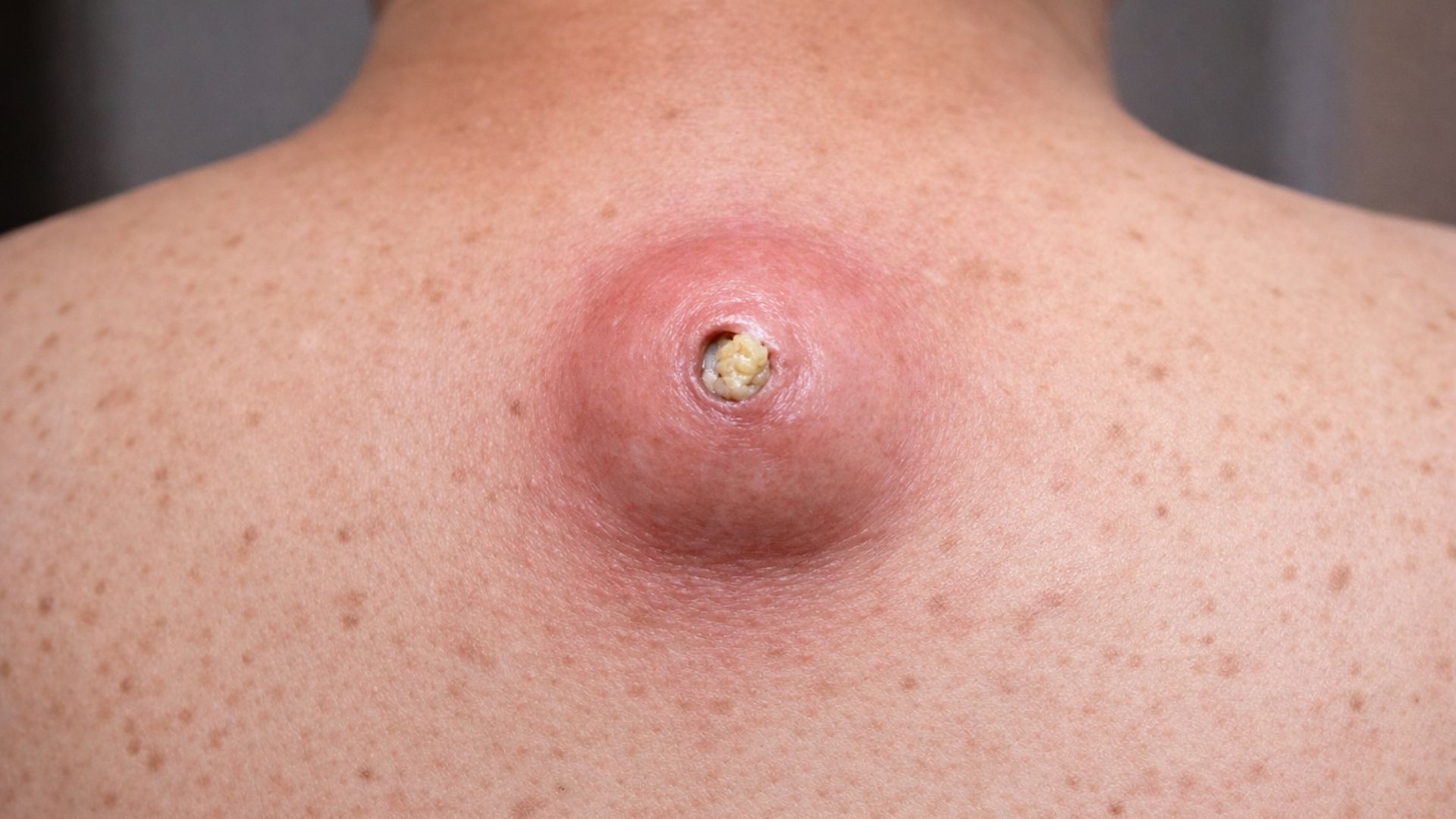 U bã đậu ở lưng là tình trạng mà rất nhiều độc giả gặp phải