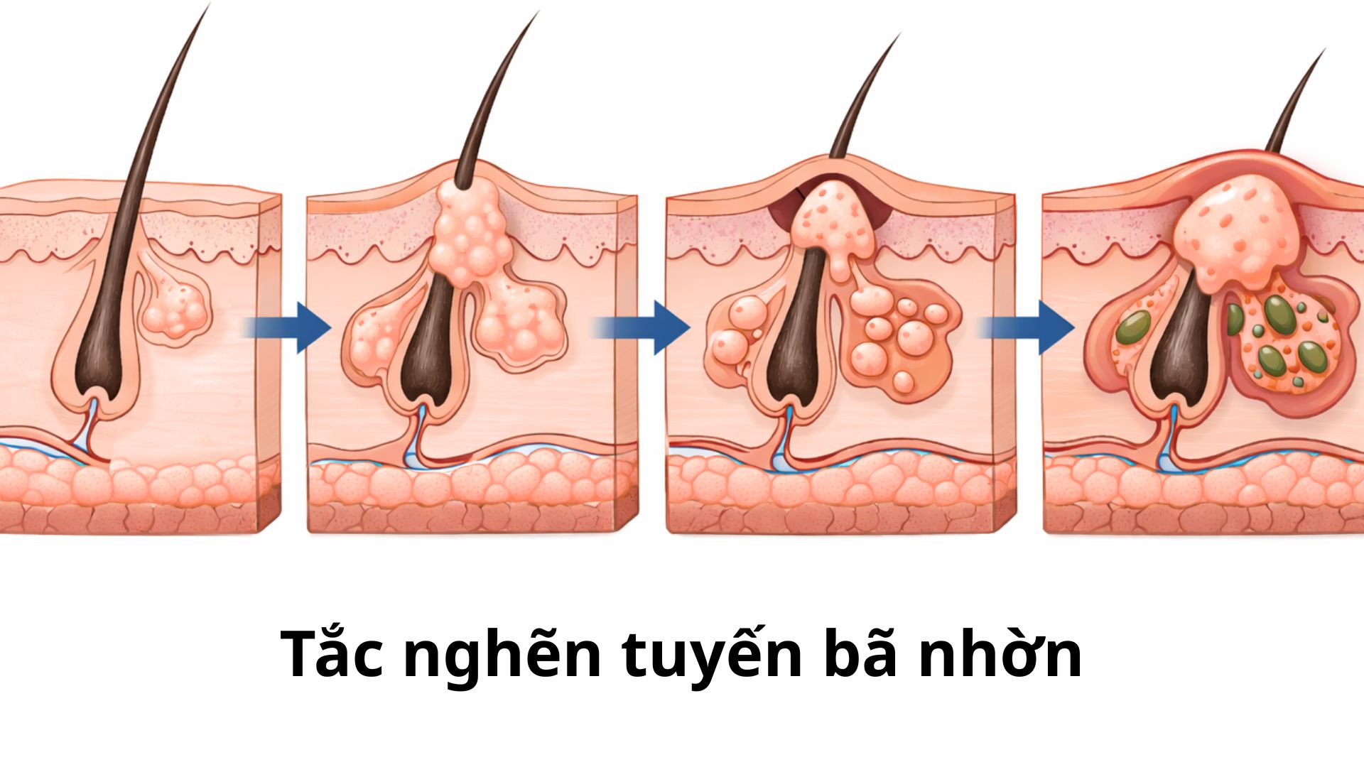 Nguyên nhân chính dẫn đến u bã đậu ở lưng là do sự tắc nghẽn tuyến bã nhờn