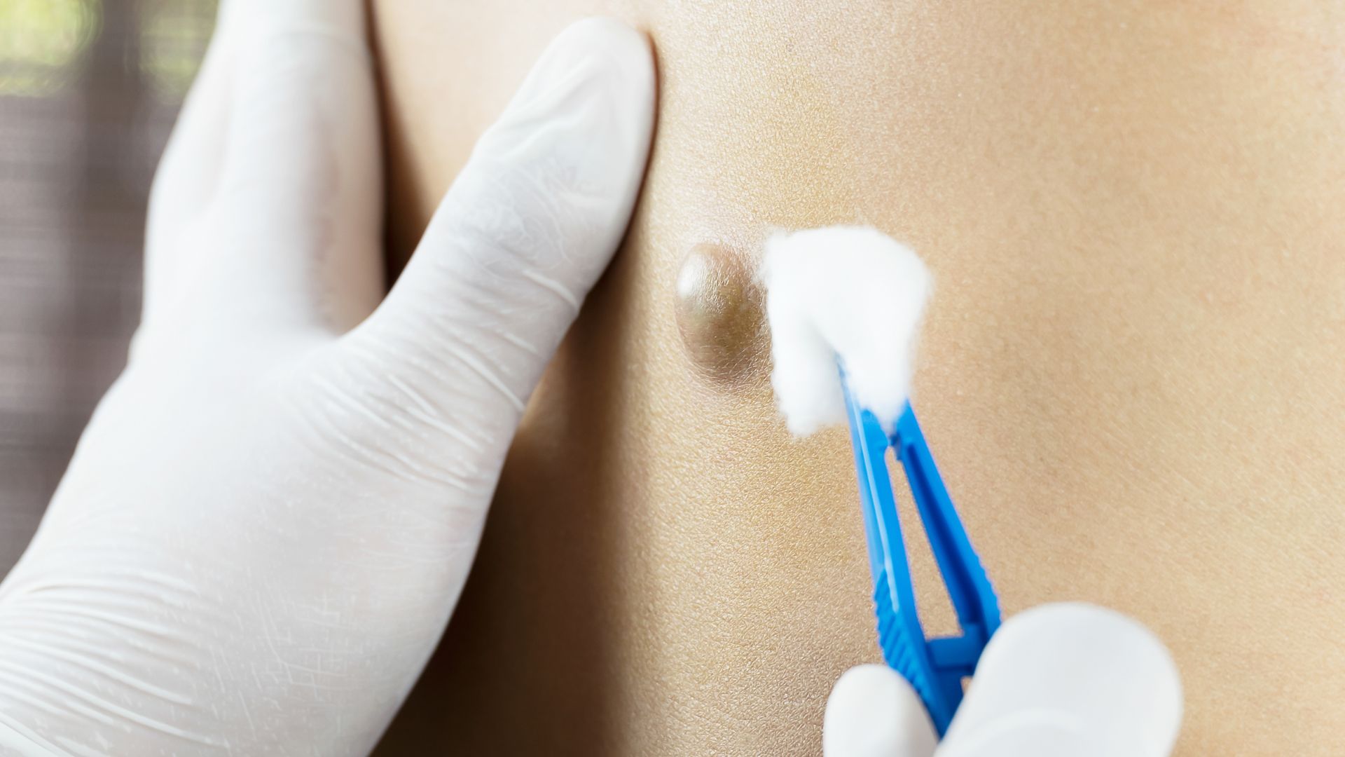 U bã đậu giai đoạn đầu thường khó nhận biết do không gây đau và khó chịu