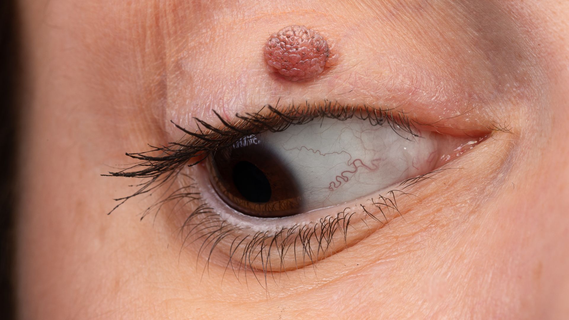 U bã đậu ở mí mắt hình thành ngay dưới mí mắt do tuyến bã nhờn hoặc nang lông bị tắc