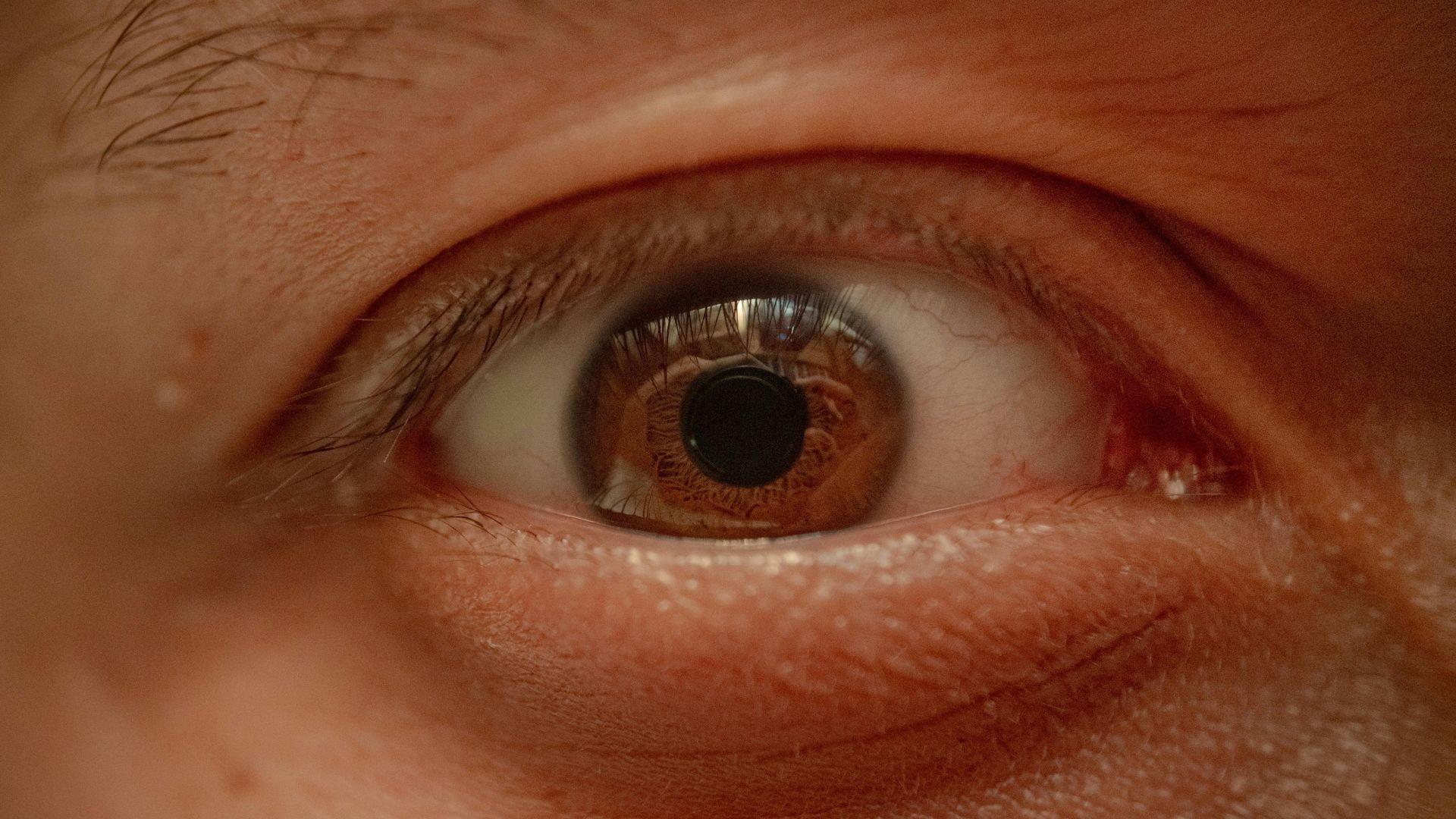 Vùng mí mắt có thể sưng đỏ khi u bã đậu hình thành