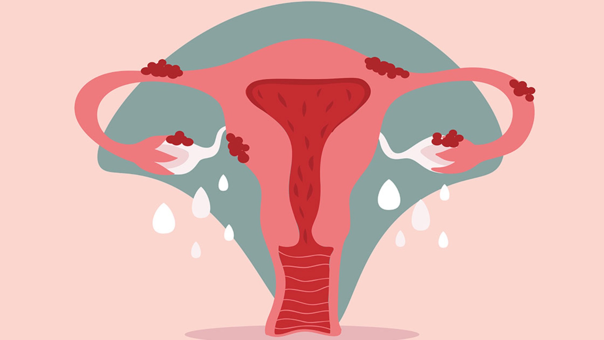 Có nhiều nguyên nhân dẫn đến ứ dịch vòi trứng