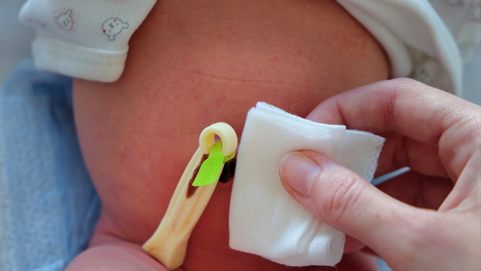 Chăm sóc đúng cách là bước quan trọng trong cách làm tan u hạt rốn