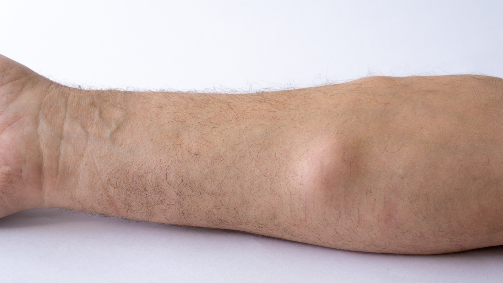 Việc hiểu đúng về u lành tính chính là chìa khóa giúp bạn bảo vệ sức khỏe lâu dài