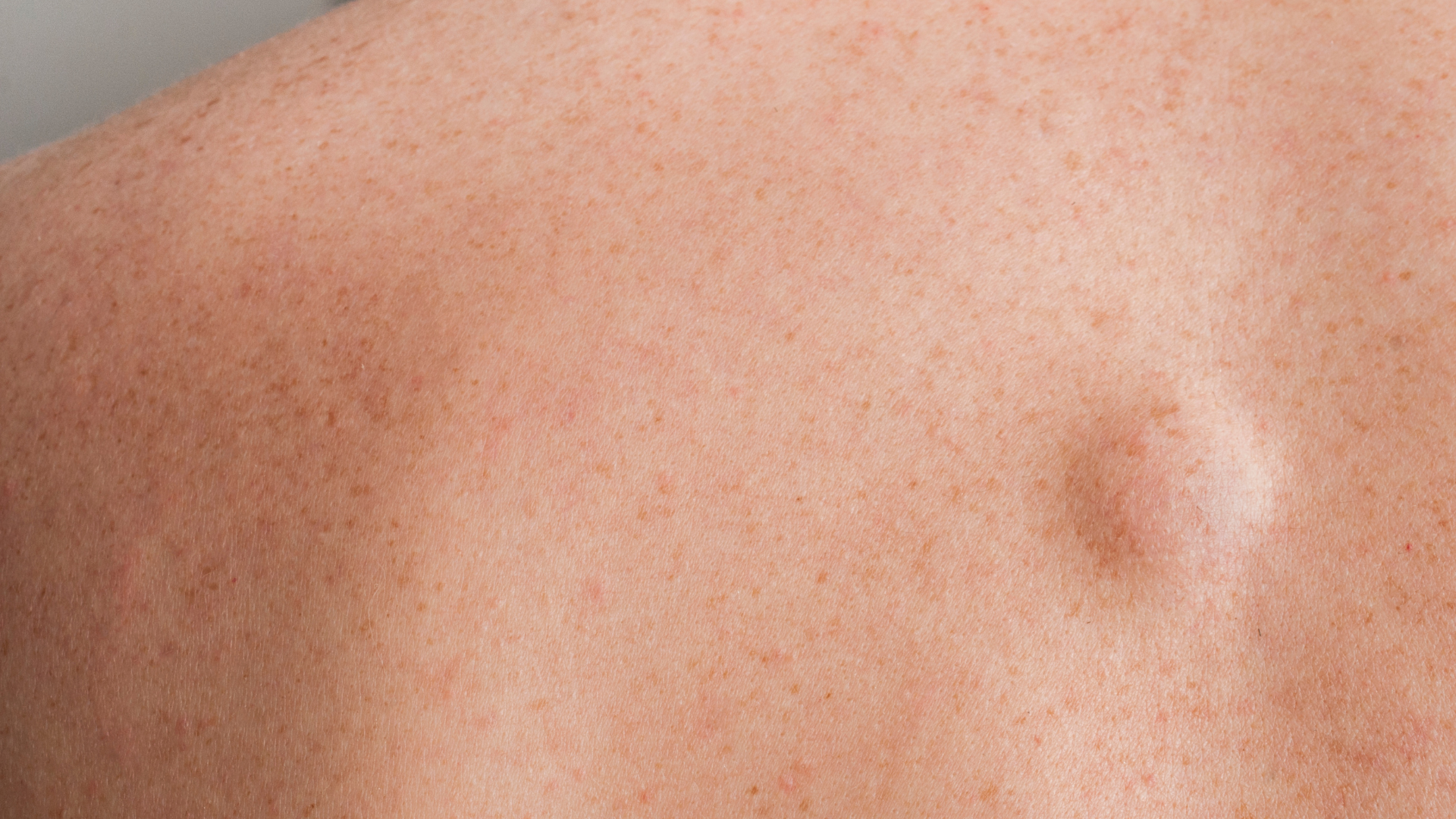 U lành tính là tình trạng khiến nhiều người lo lắng khi vô tình phát hiện trong quá trình khám sức khỏe