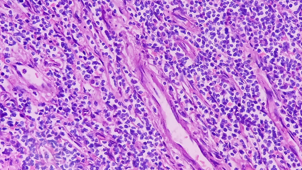 Các thể u lympho không Hodgkin phổ biến hiện nay được phân loại theo nguồn gốc tế bào lympho