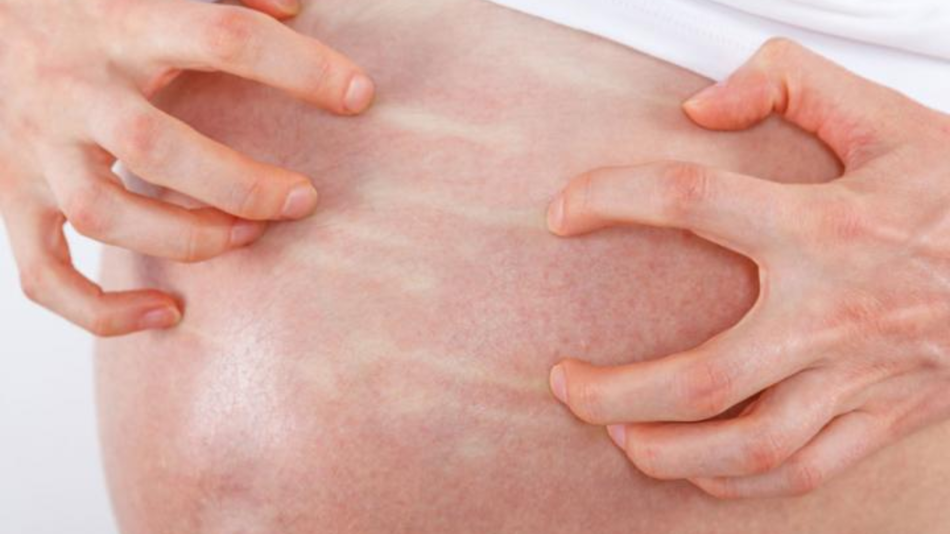 Triệu chứng điển hình và nổi bật nhất của ứ mật thai kỳ là ngứa