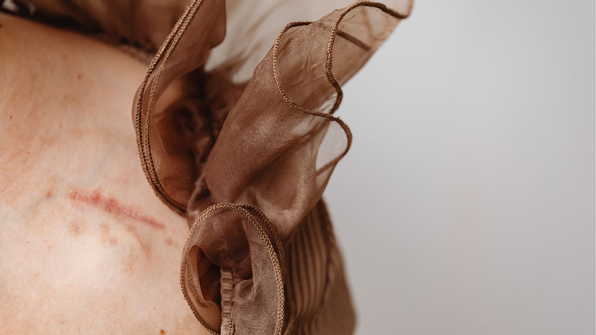 Vết thương do&nbsp;u mềm lây có thể gây sẹo vĩnh viễn