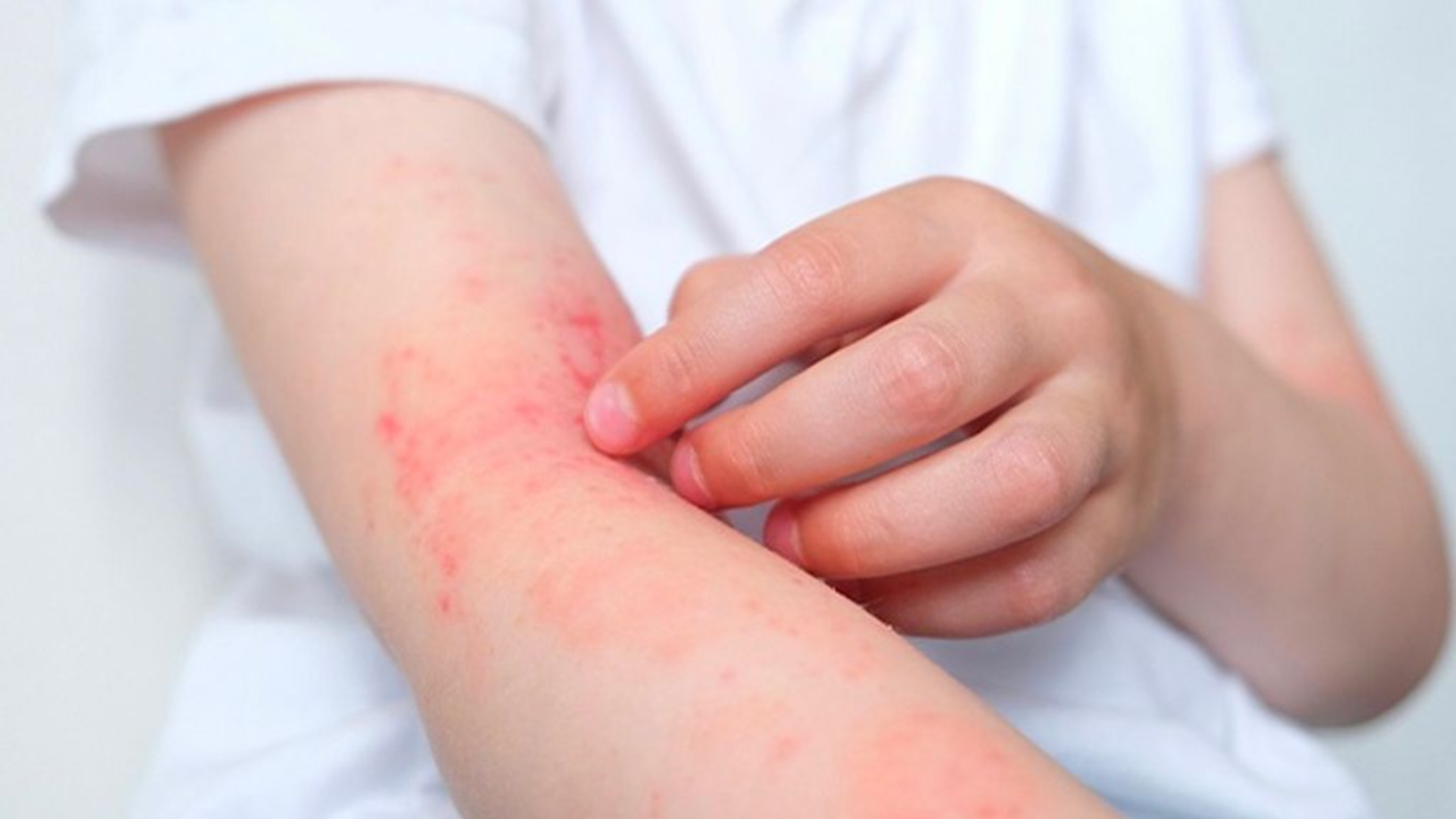 Người bị viêm da cơ địa có hàng rào da suy yếu, làm tăng nguy cơ mắc u mềm lây