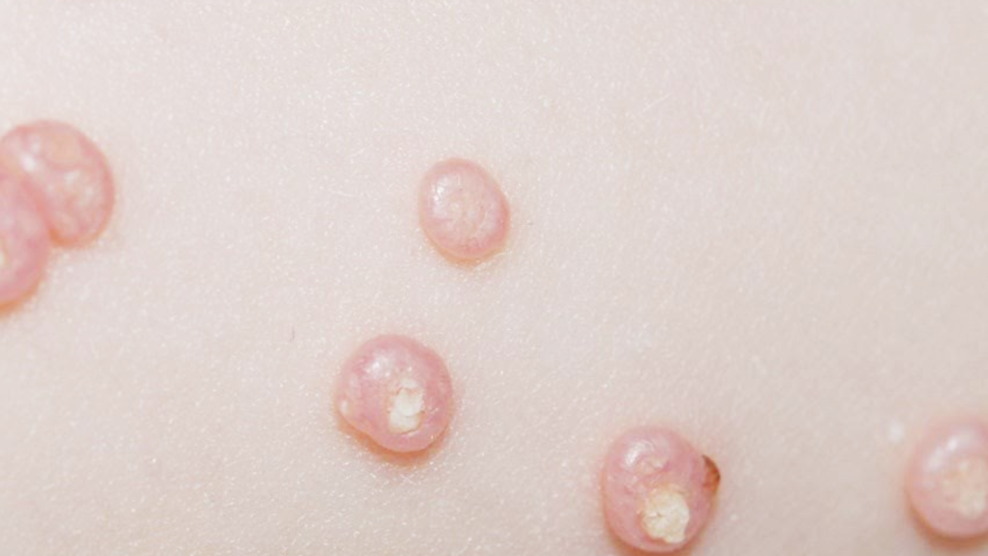 U mềm lây có tự khỏi không? Có thể tự khỏi, song quá trình này thường kéo dài nhiều tháng đến vài năm