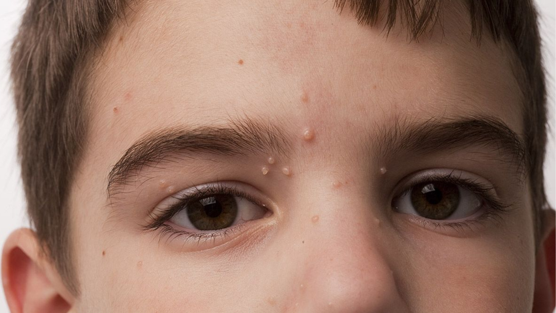 U mềm lây không tái phát từ nốt cũ, nhưng vẫn có thể nhiễm lại nếu tiếp xúc virus